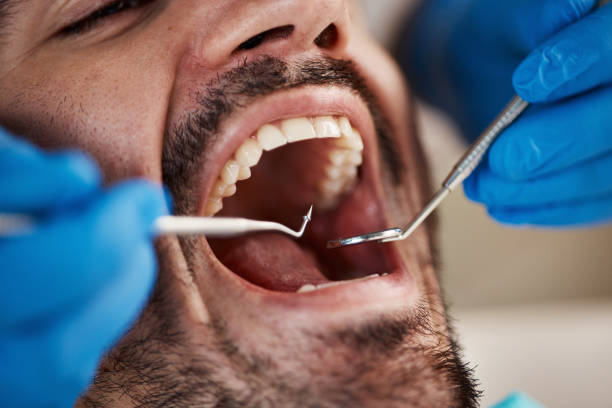 Best Emergency Dentist for Lost Fillings or Crowns in Muncy, PA